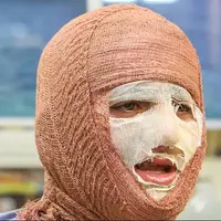 آیا بهبود کامل پس از سوختگیهای عمیق امکانپذیر است؟