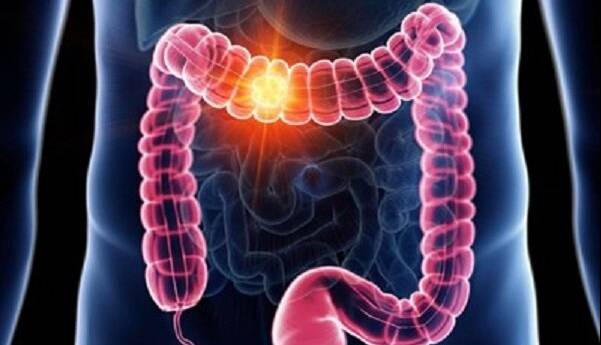 سرطان روده بزرگ؛ بررسی علل شیوع بیشتر در جوانان، علائم و نکات پیشگیری