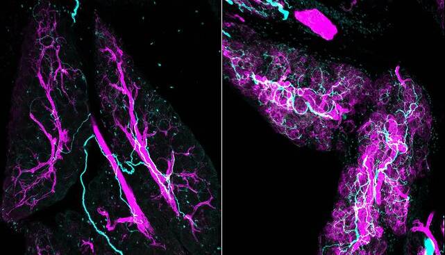 اعصاب، همدست پنهان سرطان لوزالمعده