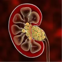 آیا خوردن شیرینی باعث سنگ کلیه می شود؟