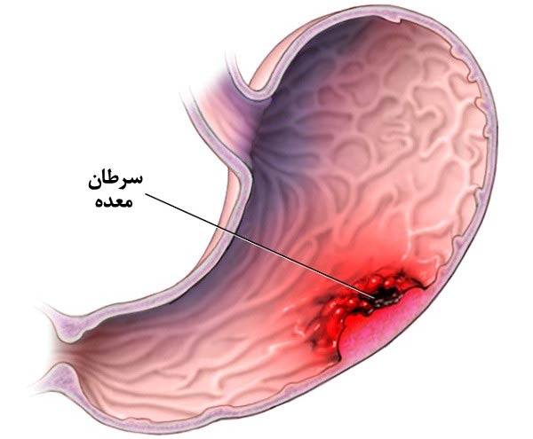فاکتورهای مؤثر در سرطان معده!