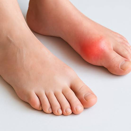 تجویز نوشیدن آب بیشتر برای همه مبتلایان به نقرس مناسب نیست