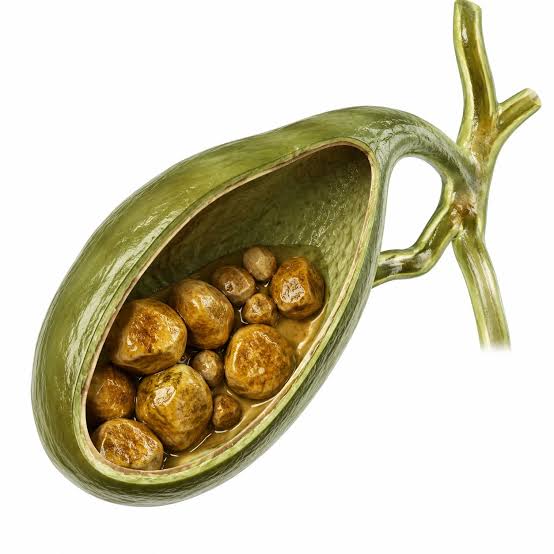 چه کسانی در معرض سنگ کیسه صفرا هستند؟