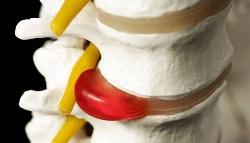 دیسک کمر همیشه به جراحی ختم نمیشود