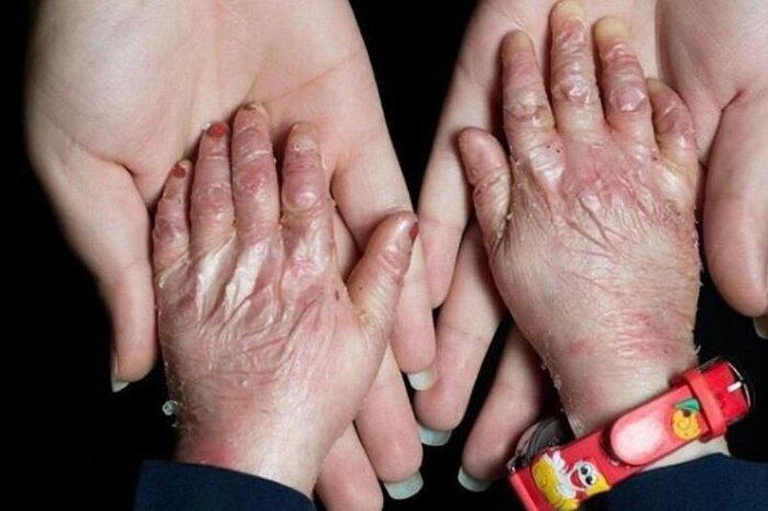 ایران غرامت تحریم بیماران پروانهای را از آمریکا گرفت